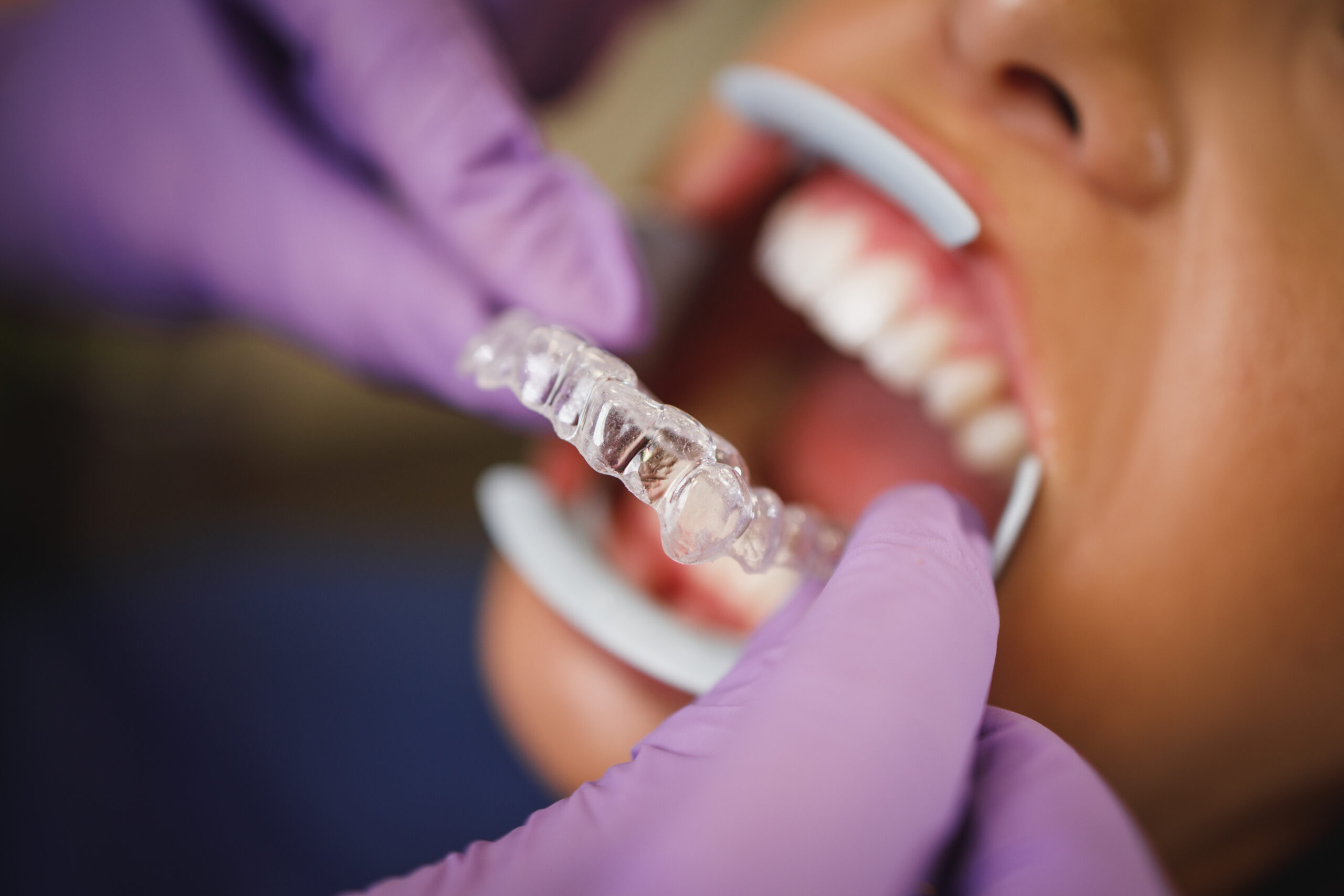 dentist placing invisalign teeth aligners
