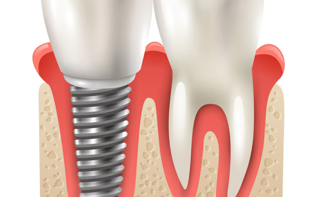 The Benefits of Dental Implants Beyond Just Aesthetics