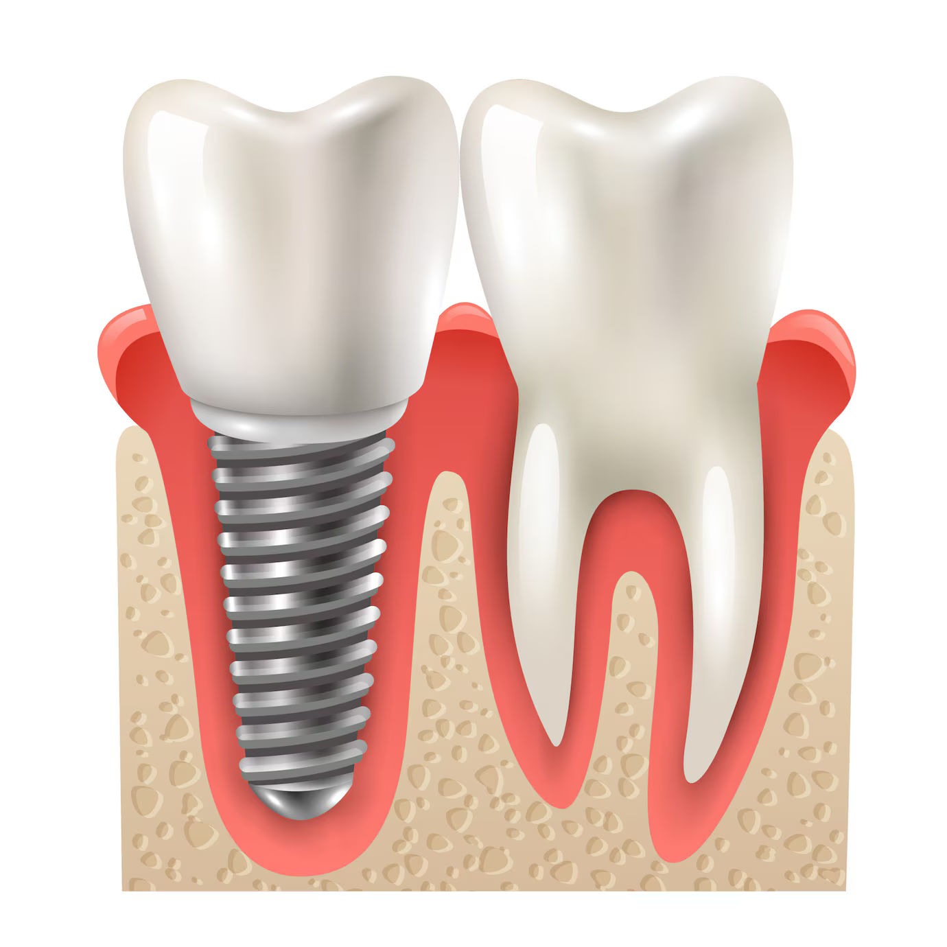 dental implant benefits functional advantages of implants
